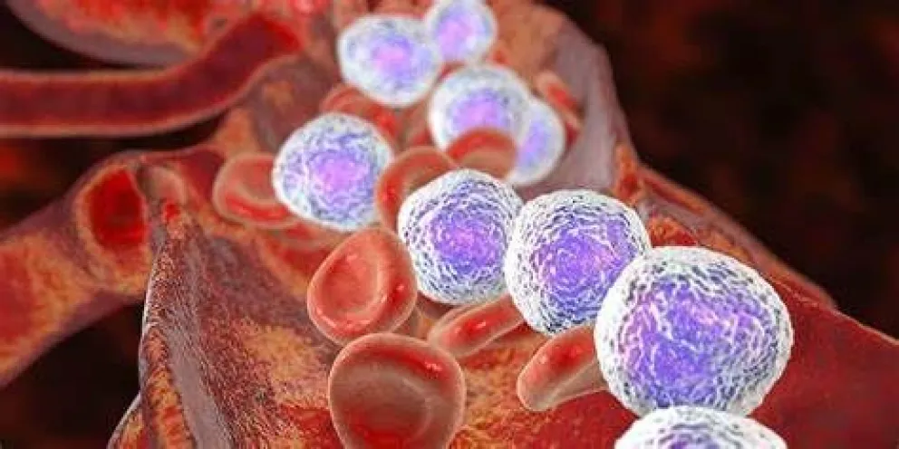 Leucemia linfocítica crónica: en Argentina se diagnostican más de 1.000 casos al año
