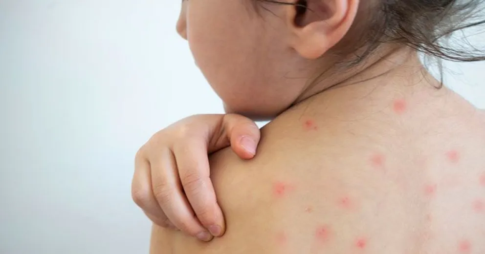 Recuerdan que la vacunación contra el sarampión es obligatoria