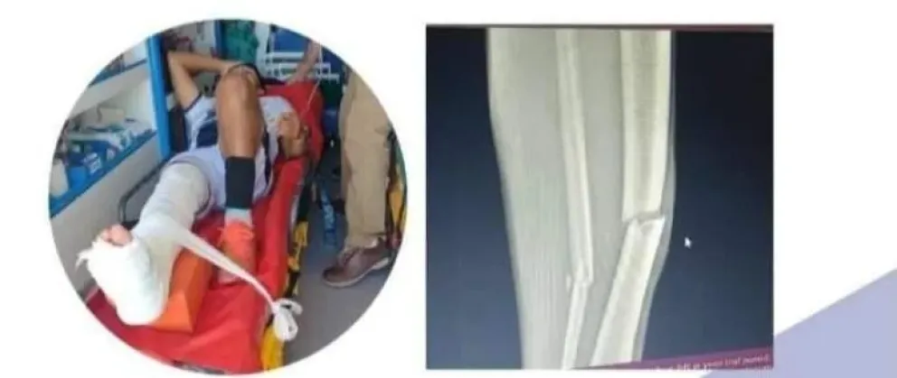 Se fracturó el pie, necesita una intervención quirúrgica urgente y su familia realizó una colecta solidaria