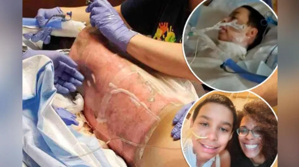 Niño de 12 años terminó con la mitad del cuerpo quemado tras realizar un desafío viral 