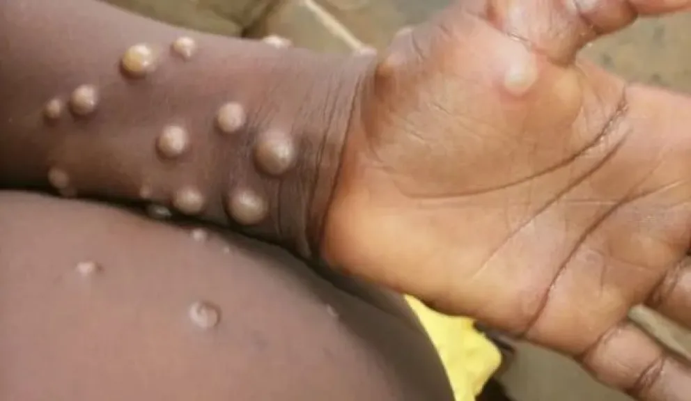 Viruela del Mono: cómo evolucionan los primeros síntomas y en qué casos puede producir la muerte