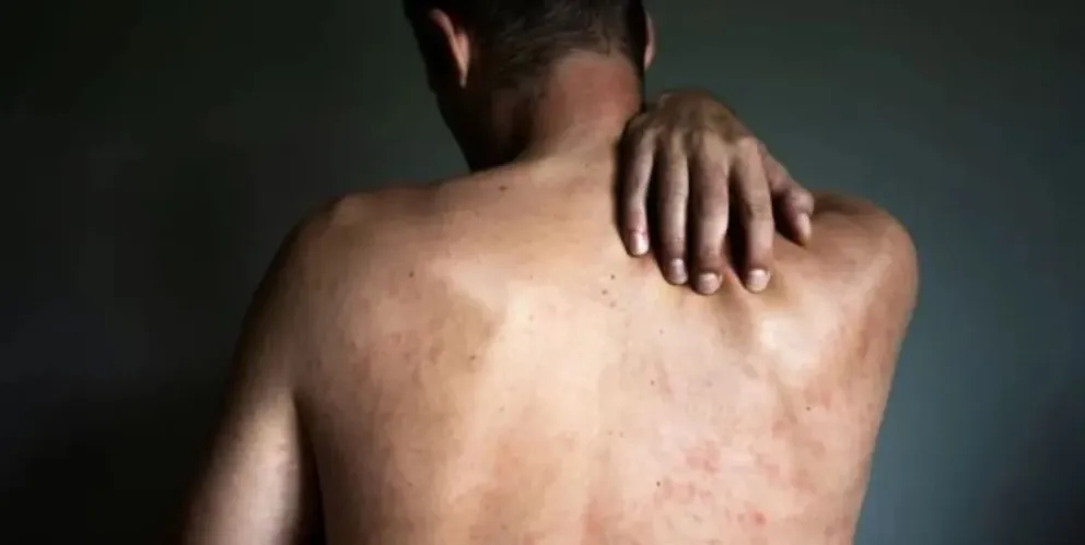 Cómo evoluciona el estado de salud del cipoleño infectado con el virus de la “Viruela del mono”